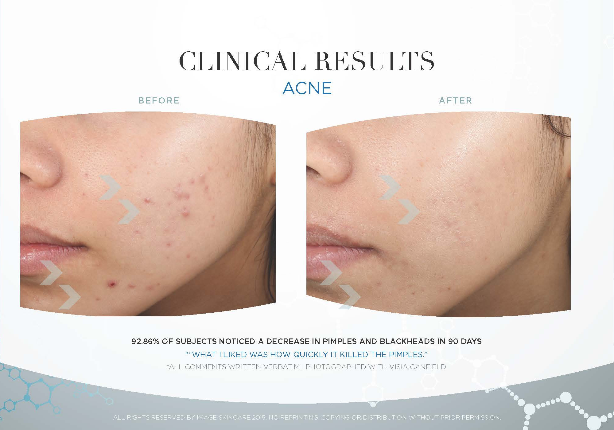 Acne-Clinical-Results